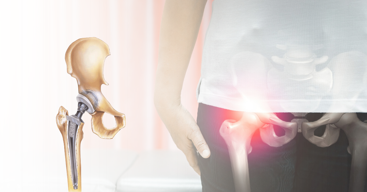 5 Conditions that Require Hip Replacement Surgery